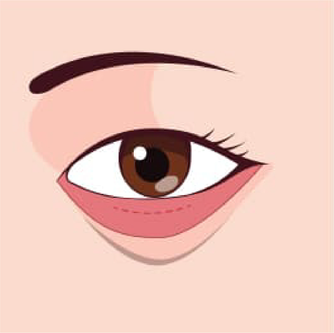 內開眼袋手術